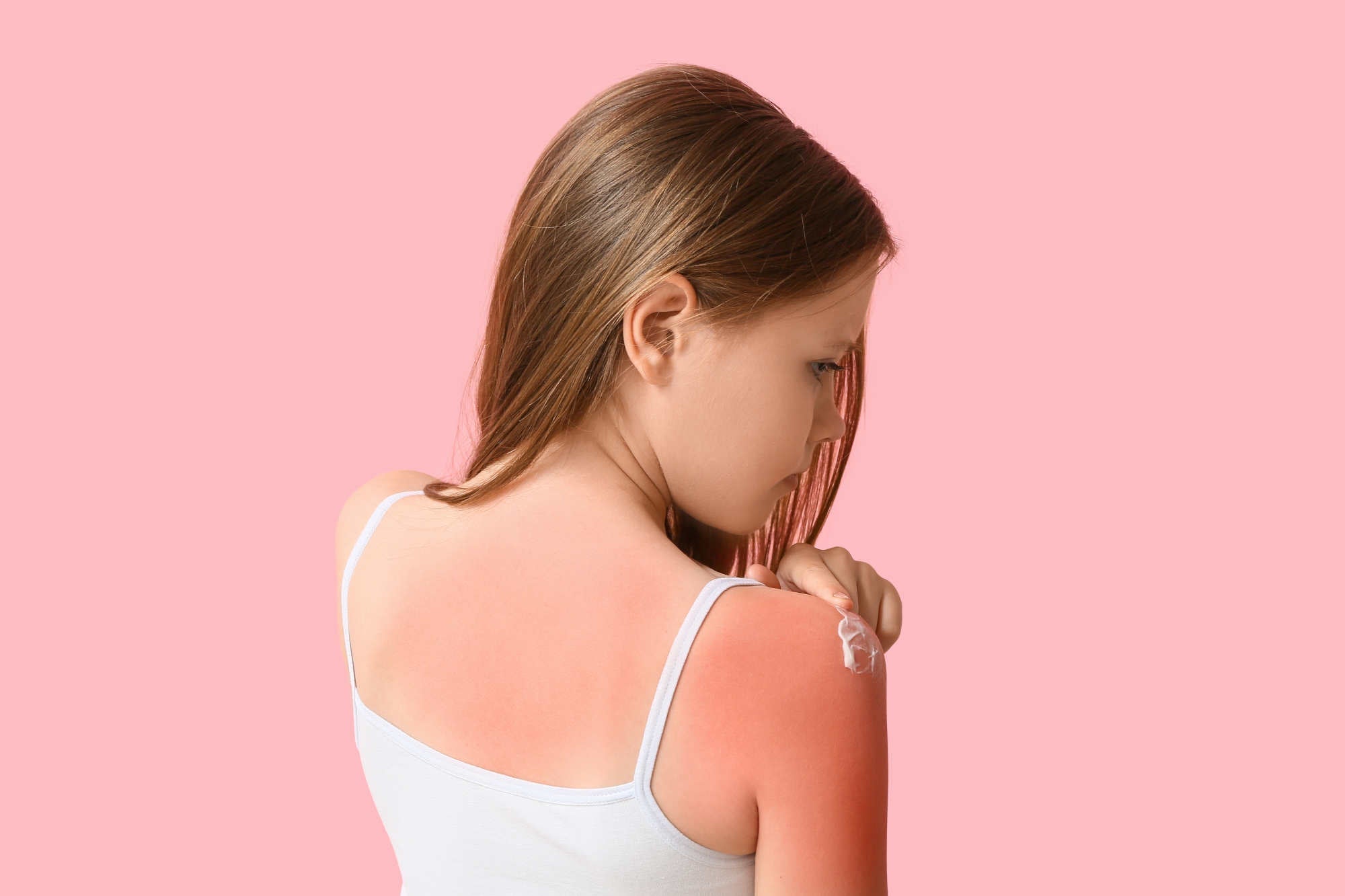 Rimedi naturali per le scottature da sole e consigli pratici di prevenzione