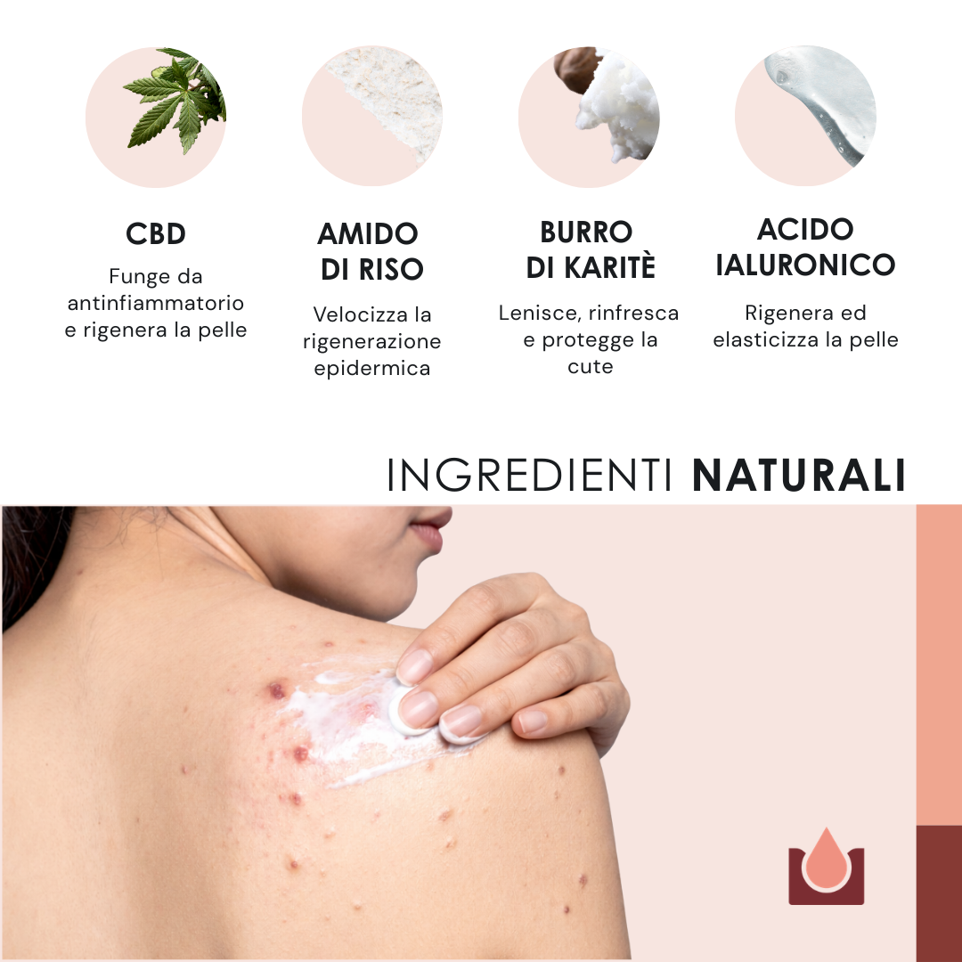 Crema naturale per acne - 2x50ml-10388154909019