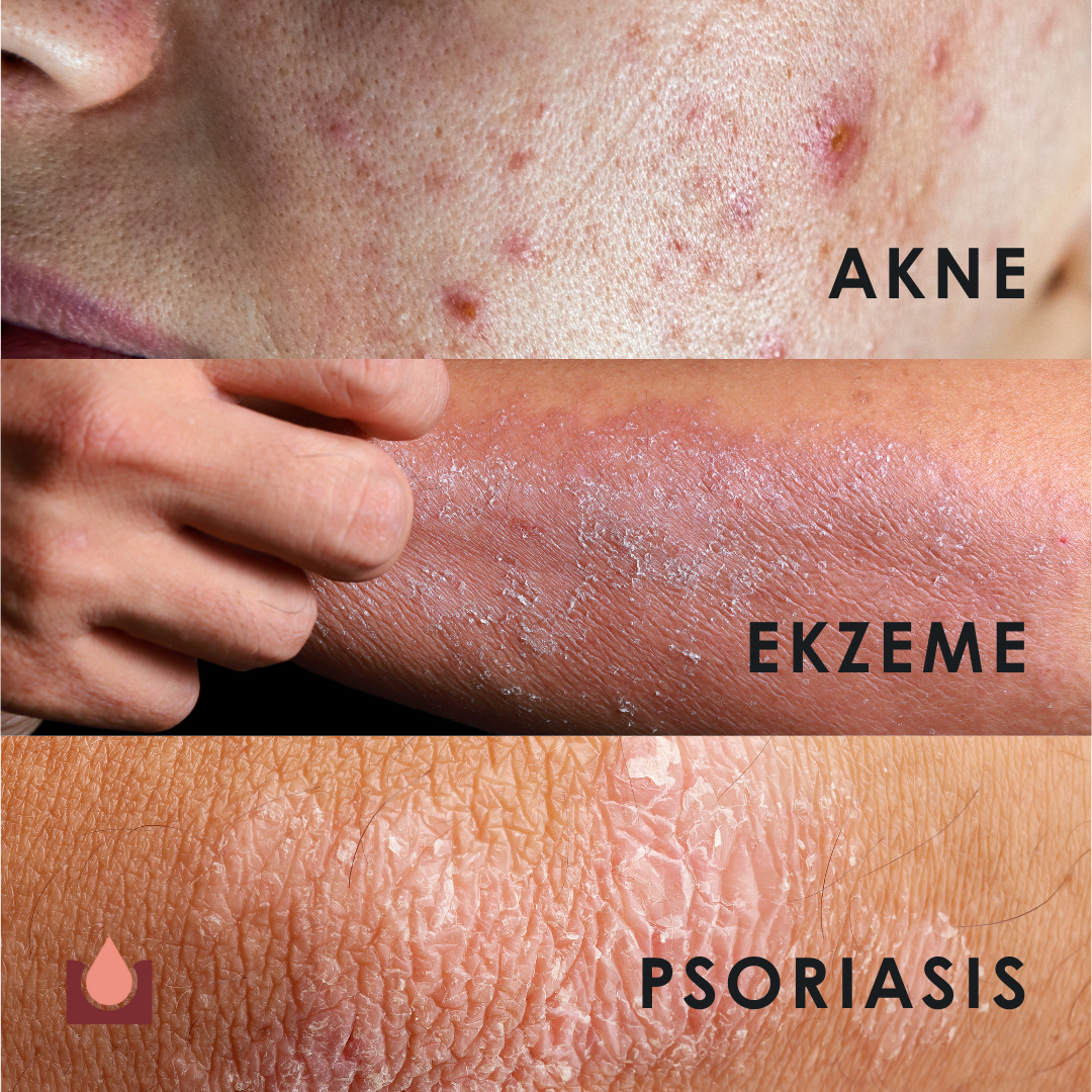 EU4DERMA - Natürliche Beruhigungscreme für Gesicht und Körper bei Ekzemen, Akne und Schuppenflechte - 50 ml