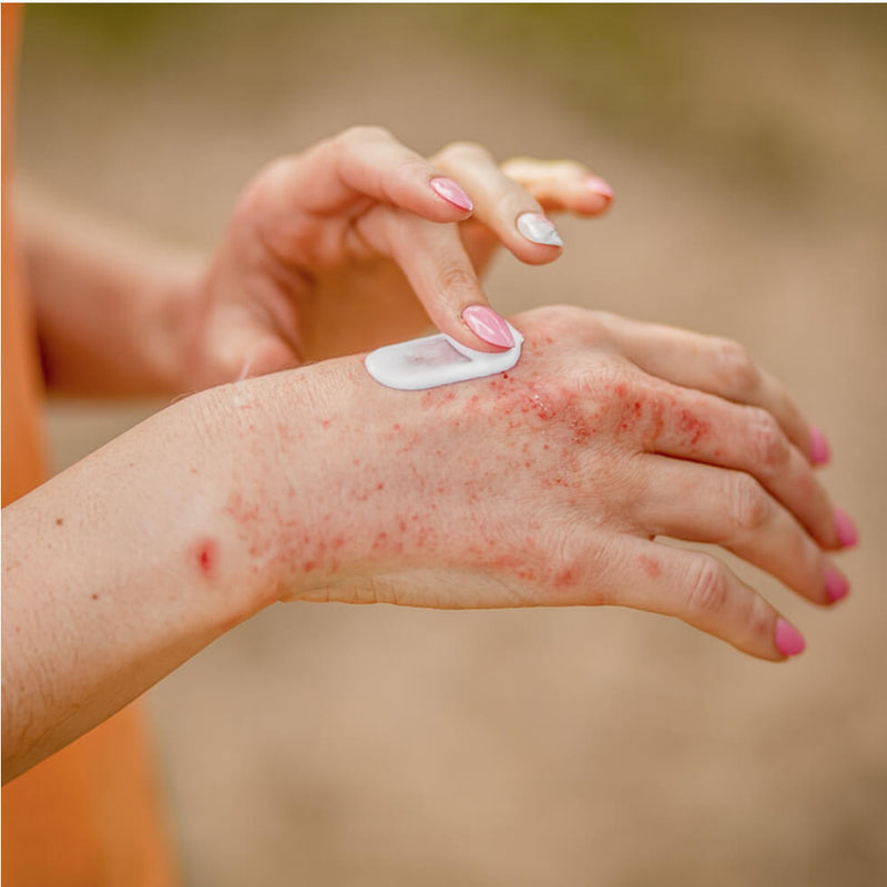 Hemp Cream Derma: la crema al CBD per pelle sensibile, secca e con condizioni cutanee
